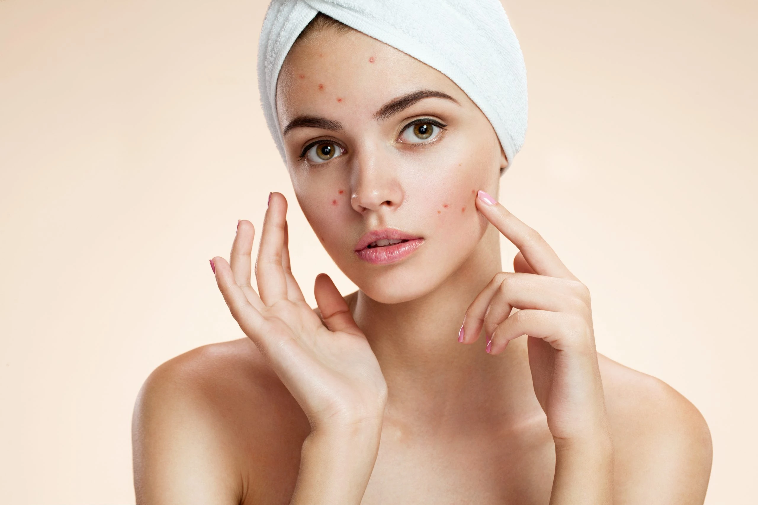 Can acne be cured forever?