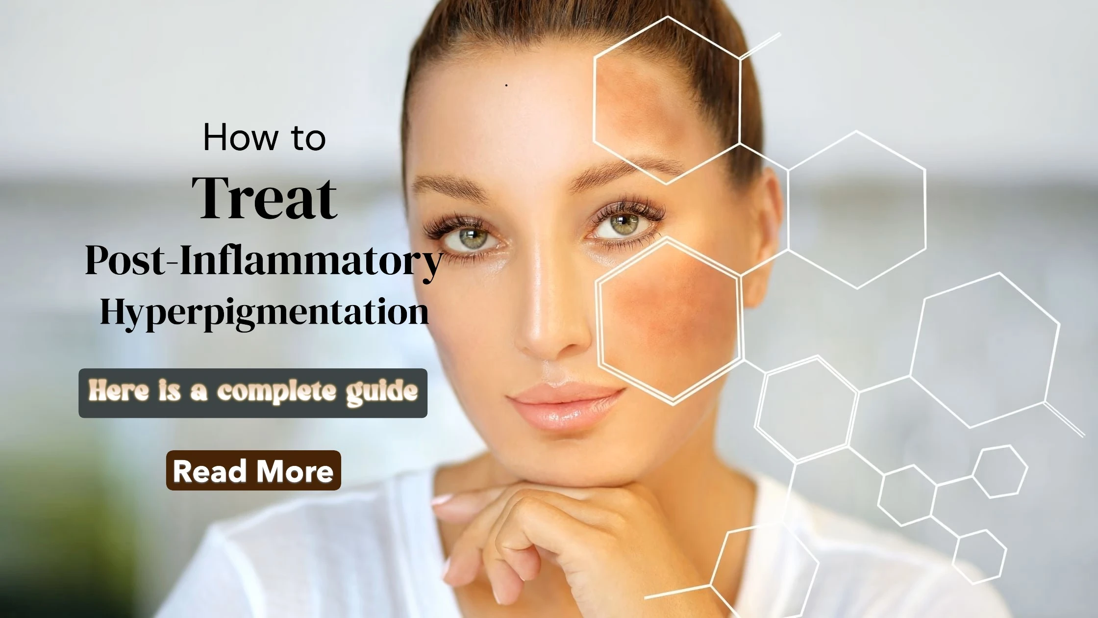 How to Treat Post-Inflammatory Hyperpigmentation: Effective Solutions for Even-Toned Skin