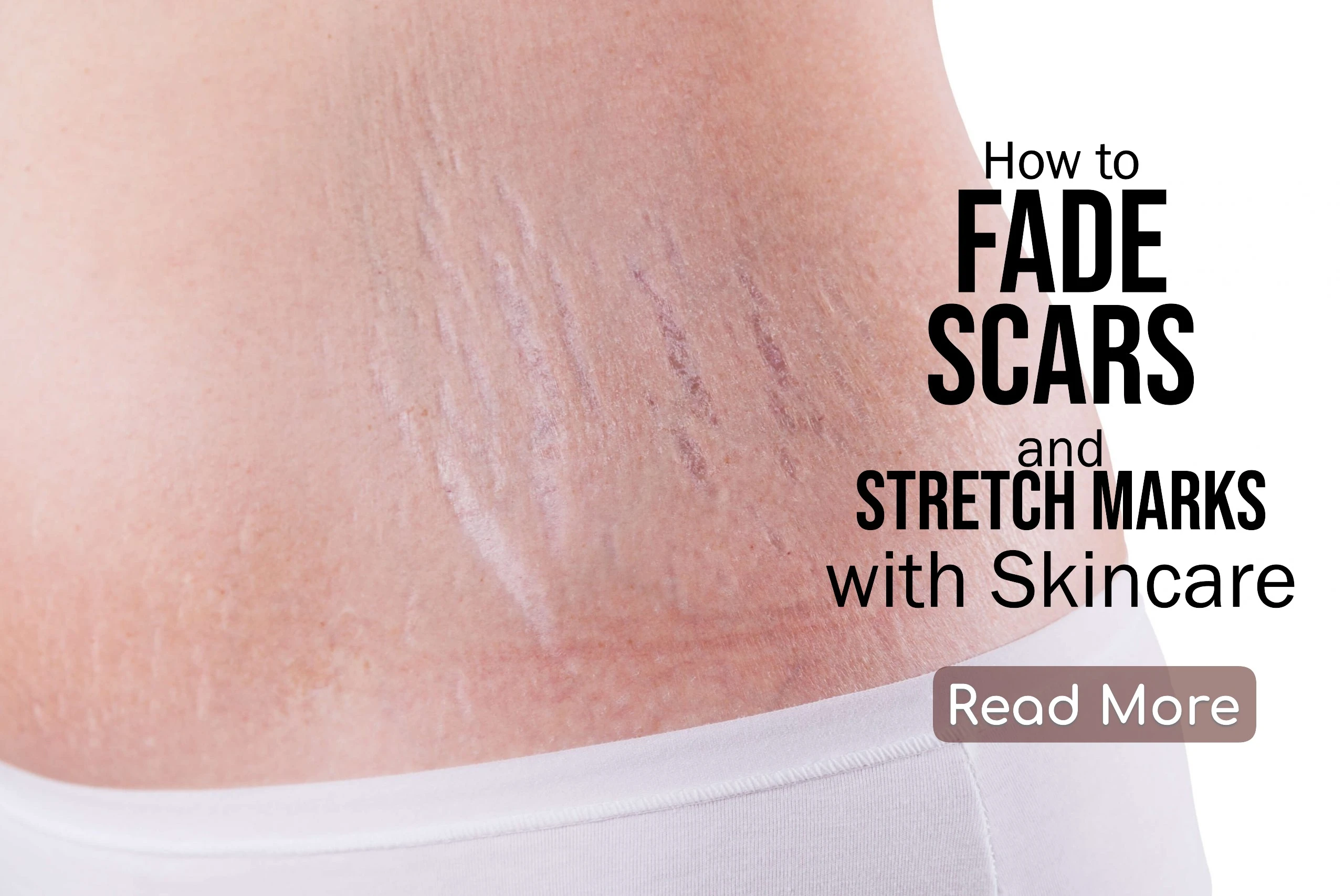 How to Fade Scars and Stretch Marks with Skincare: Effective Ingredients and Techniques That Work