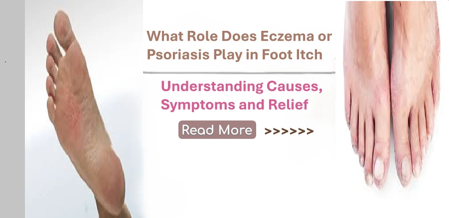 What Role Does Eczema or Psoriasis Play in Foot Itch? Understanding Causes, Symptoms, and Relief