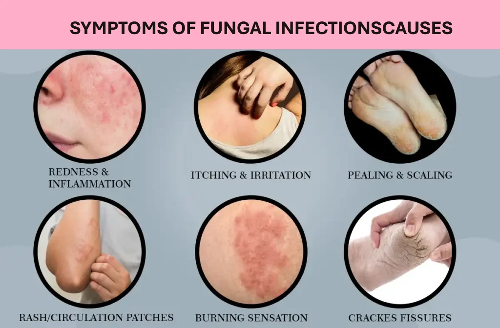 How Can You Tell if a Fungal Infection Is Causing the Itch? Recognizing Signs and Symptoms for Timely Care