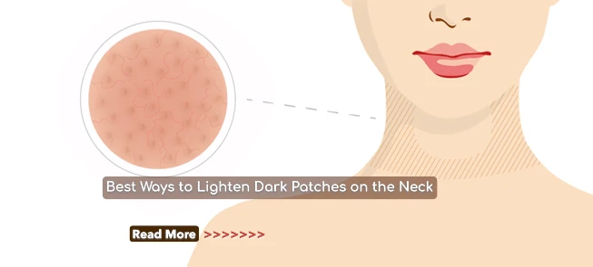 Best Ways to Lighten Dark Patches on the Neck: Effective Treatments and Home Remedies