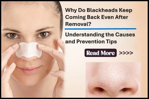 Why Do Blackheads Keep Coming Back Even After Removal? Understanding the Causes and Prevention Tips