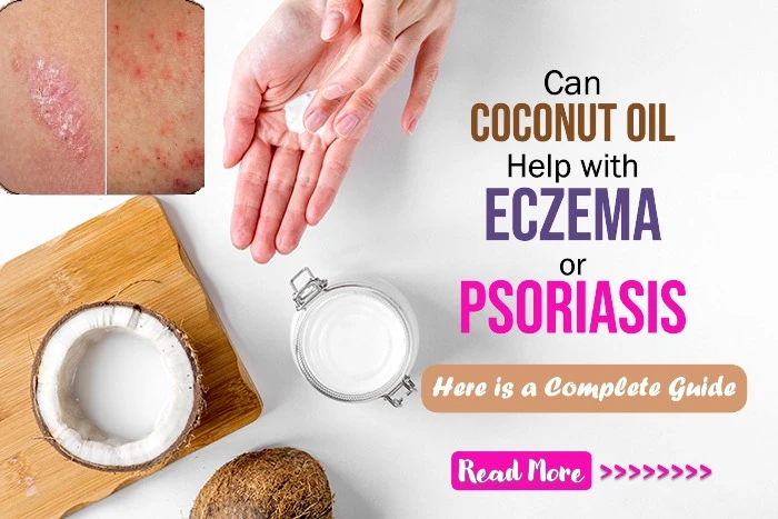 Can Coconut Oil Help with Eczema or Psoriasis? Exploring Its Soothing Benefits for Inflamed Skin Conditions