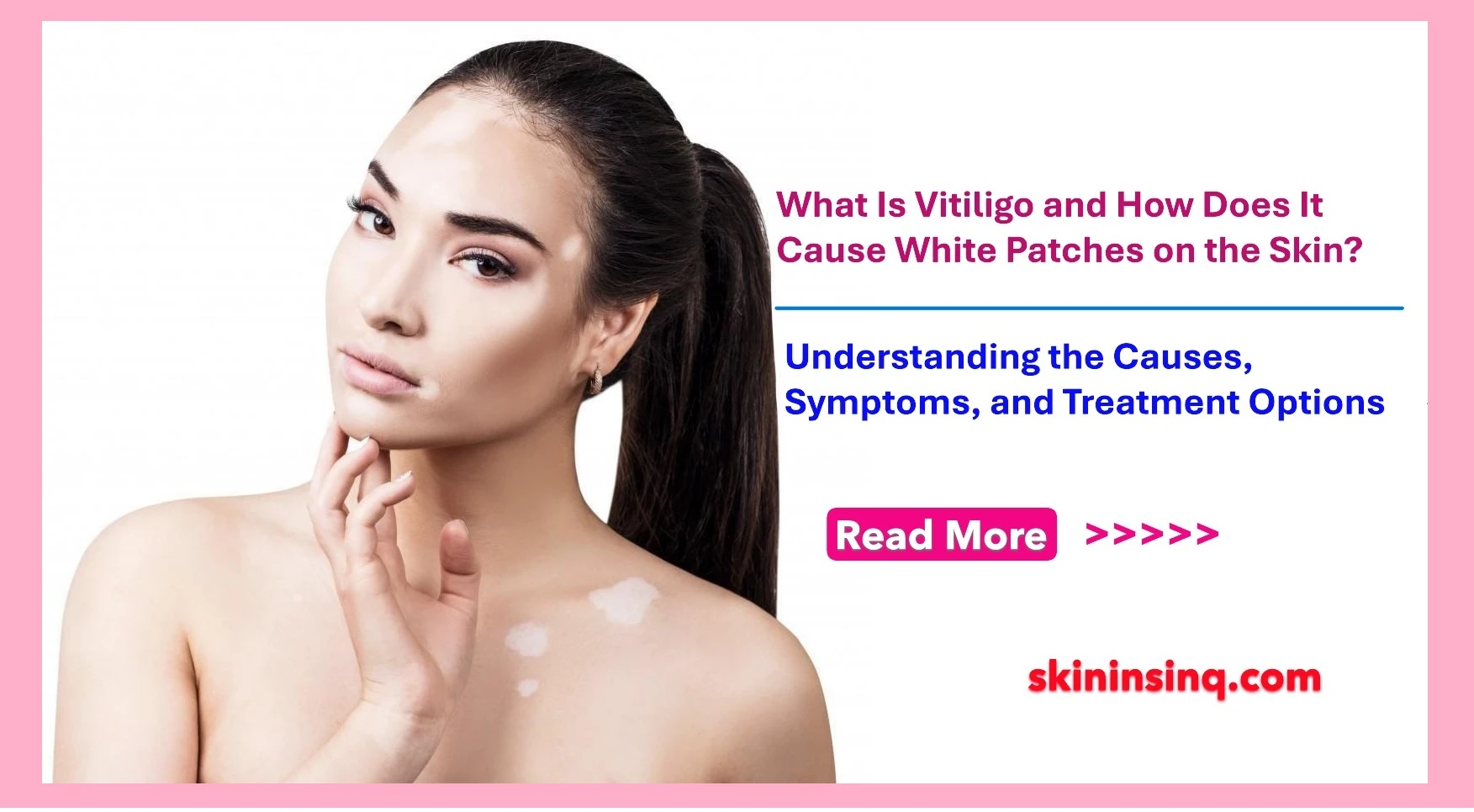 What Is Vitiligo and How Does It Cause White Patches on the Skin? Understanding the Causes, Symptoms, and Treatment Options