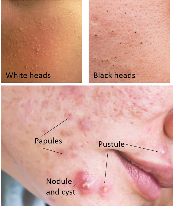 Stages of acne - basics explained by a dermatologist