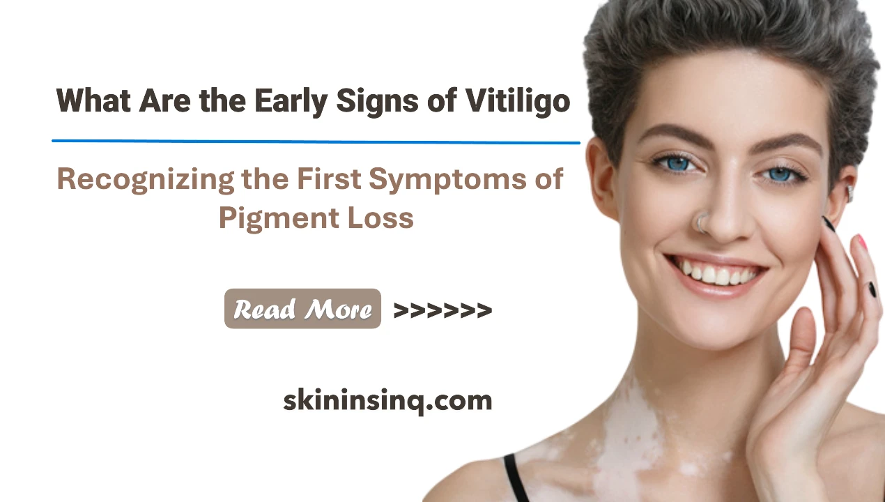 What Are the Early Signs of Vitiligo? Recognizing the First Symptoms of Pigment Loss