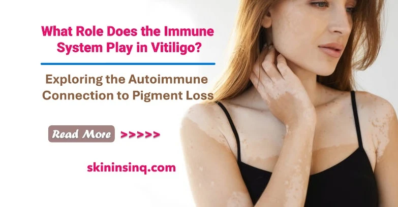 What Role Does the Immune System Play in Vitiligo? Exploring the Autoimmune Connection to Pigment Loss