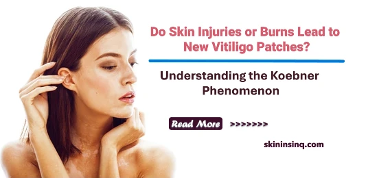 Do Skin Injuries or Burns Lead to New Vitiligo Patches? Understanding the Koebner Phenomenon