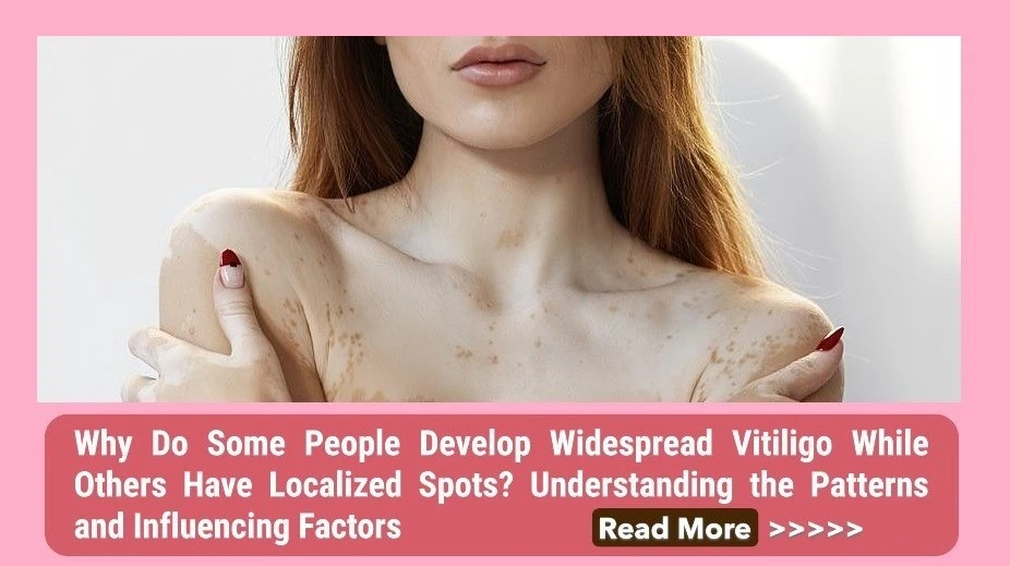 Why Do Some People Develop Widespread Vitiligo While Others Have Localized Spots? Understanding the Patterns and Influencing Factors