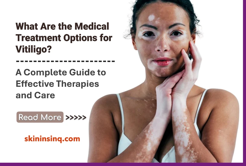What Are the Medical Treatment Options for Vitiligo? A Complete Guide to Effective Therapies and Care
