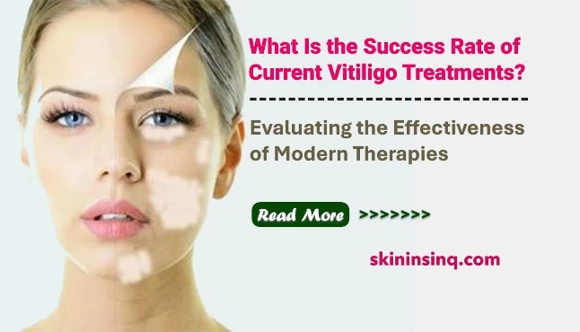 What Is the Success Rate of Current Vitiligo Treatments? Evaluating the Effectiveness of Modern Therapies