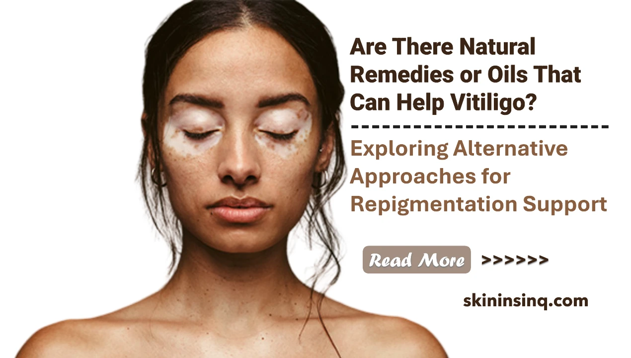 Are There Natural Remedies or Oils That Can Help Vitiligo? Exploring Alternative Approaches for Repigmentation Support