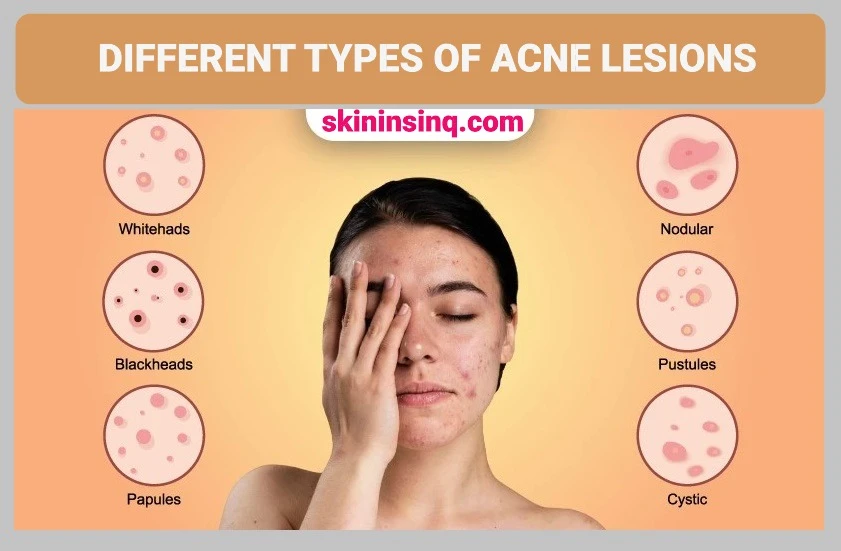 What Are the Different Types of Acne Lesions? Understanding Blackheads, Whiteheads, Pustules, Nodules, and Cysts