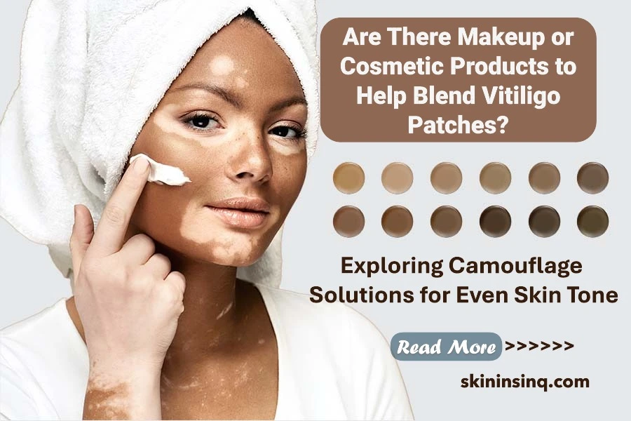 Are There Makeup or Cosmetic Products to Help Blend Vitiligo Patches? Exploring Camouflage Solutions for Even Skin Tone