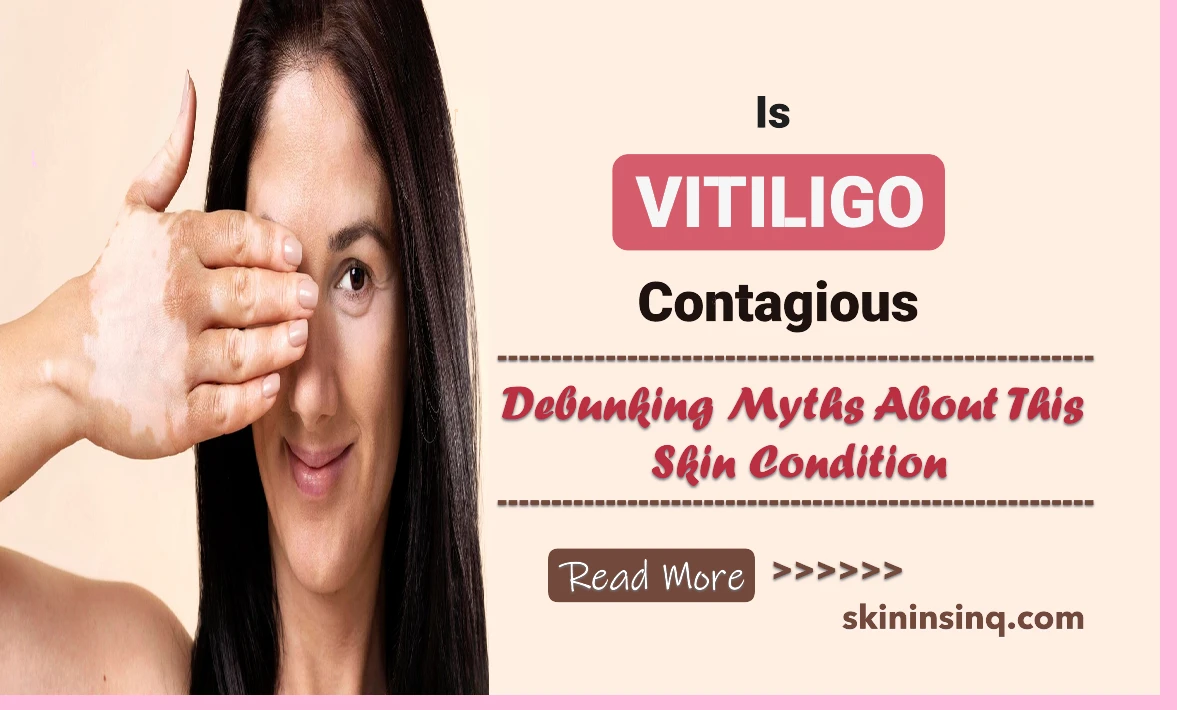 Is Vitiligo Contagious? Debunking Myths About This Skin Condition