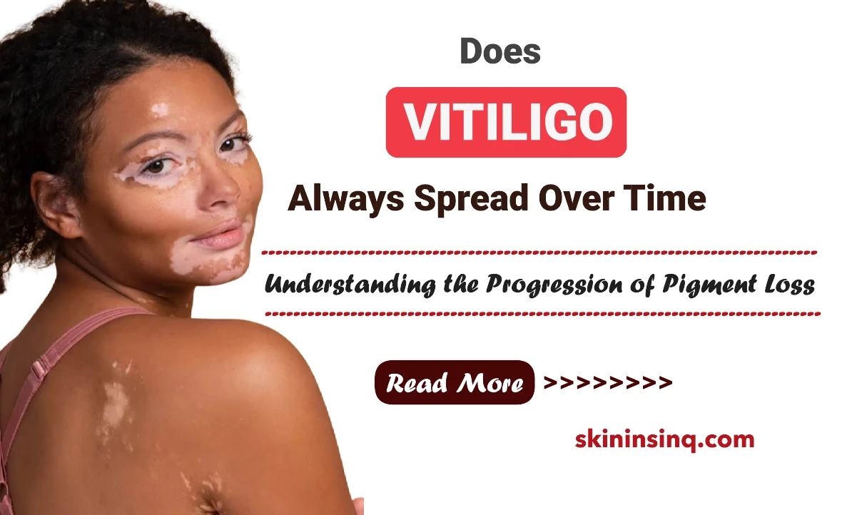 Does Vitiligo Always Spread Over Time? Understanding the Progression of Pigment Loss