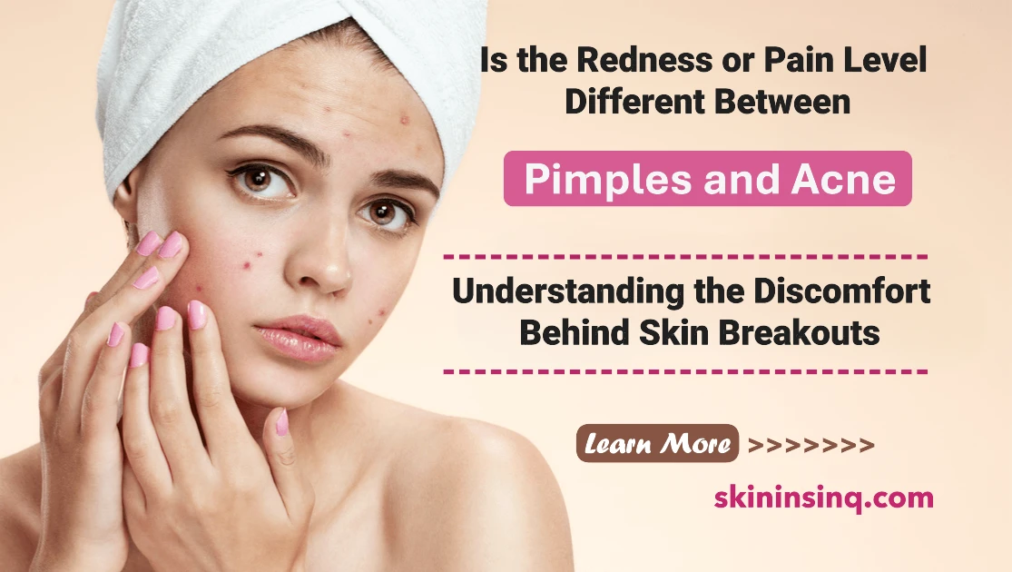 Is the Redness or Pain Level Different Between Pimples and Acne? Understanding the Discomfort Behind Skin Breakouts