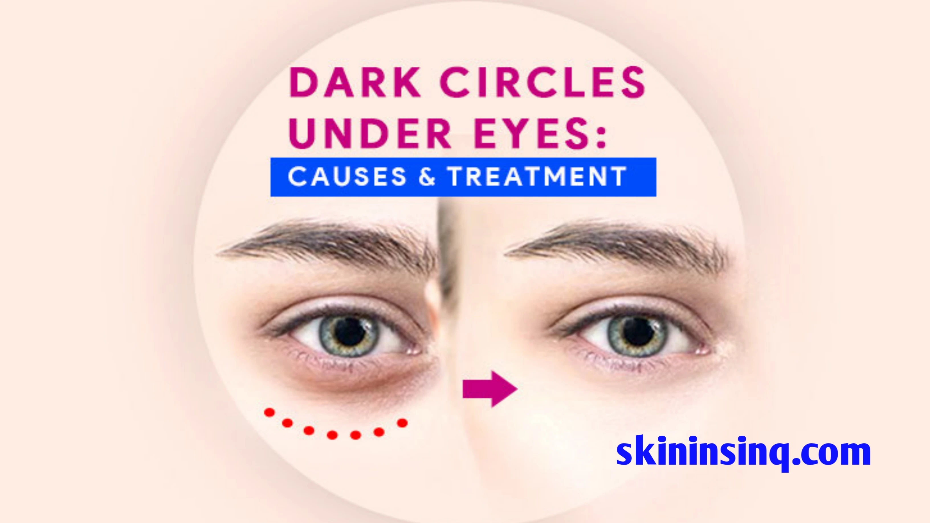 What Causes Dark Circles Under the Eyes? Exploring Common Triggers and Underlying Factors