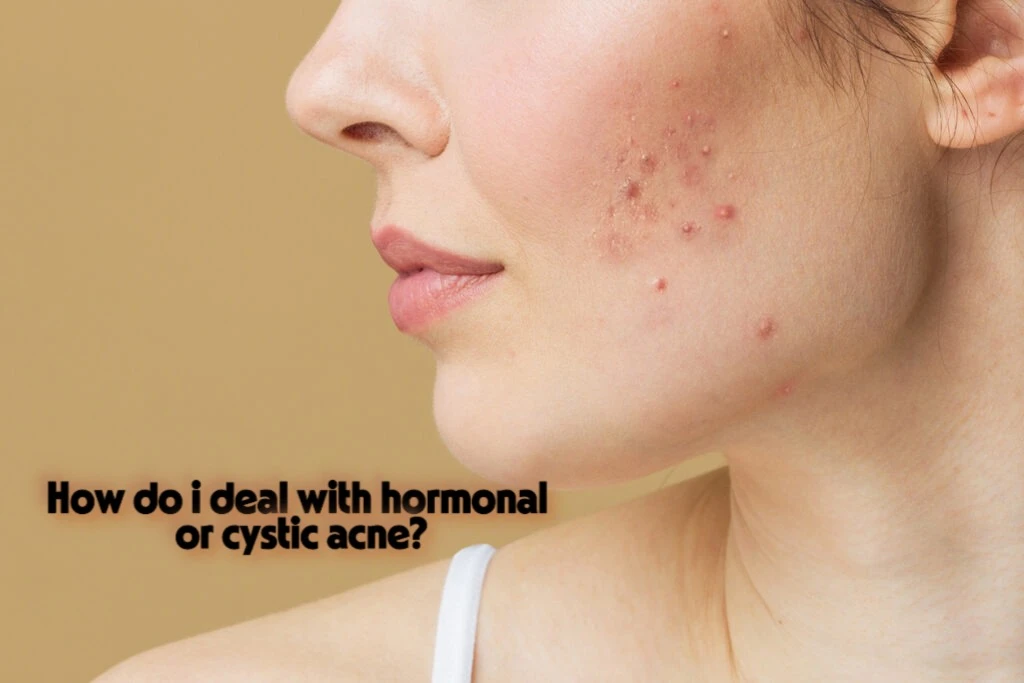 How do i deal with hormonal or cystic acne?