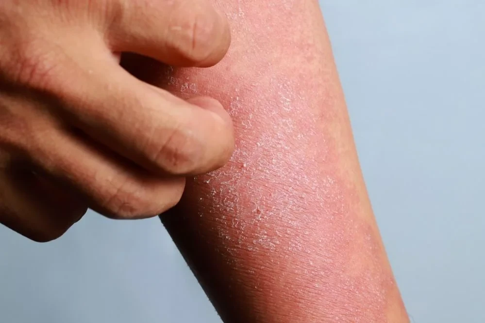 The Unknown Truth About Eczema: Understanding, Managing, and Treating Dermatitis